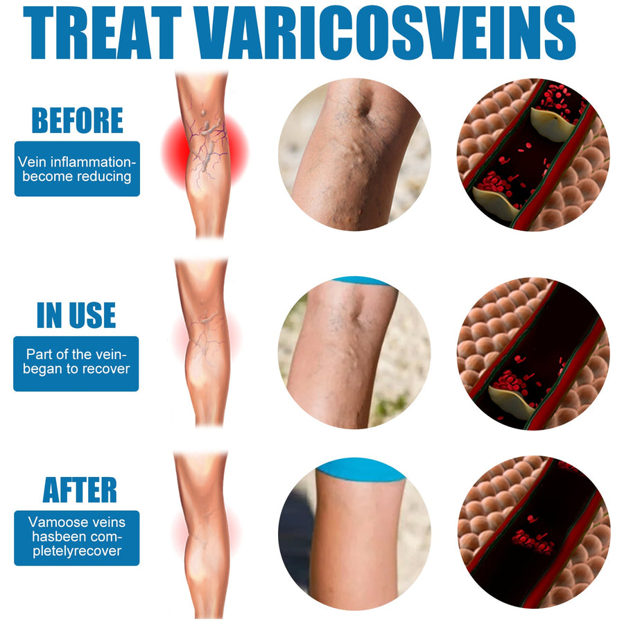 Leg Varicose Vein Treatment Spray — Reduced Appearance, No