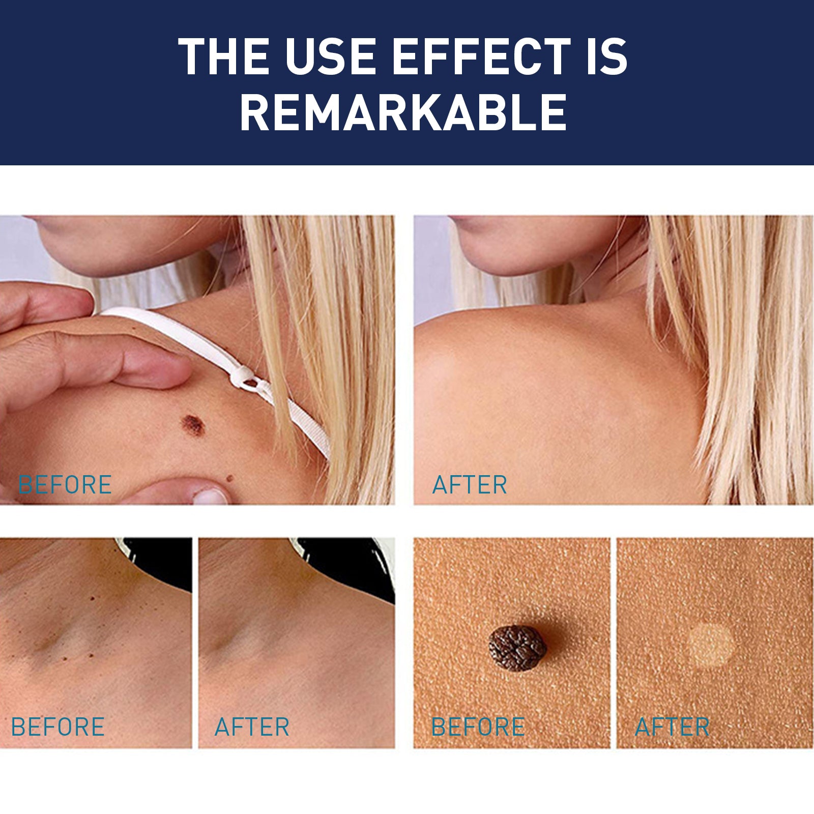 Multiple before-and-after scenarios: neck/shoulder skin tag removal, underarm treatment, and close-up mole/wart fading
