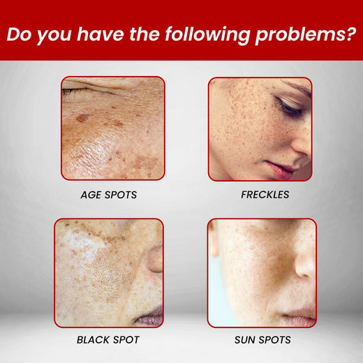 Dark Spot Corrector Cream for Fading Age Spots & Freckles