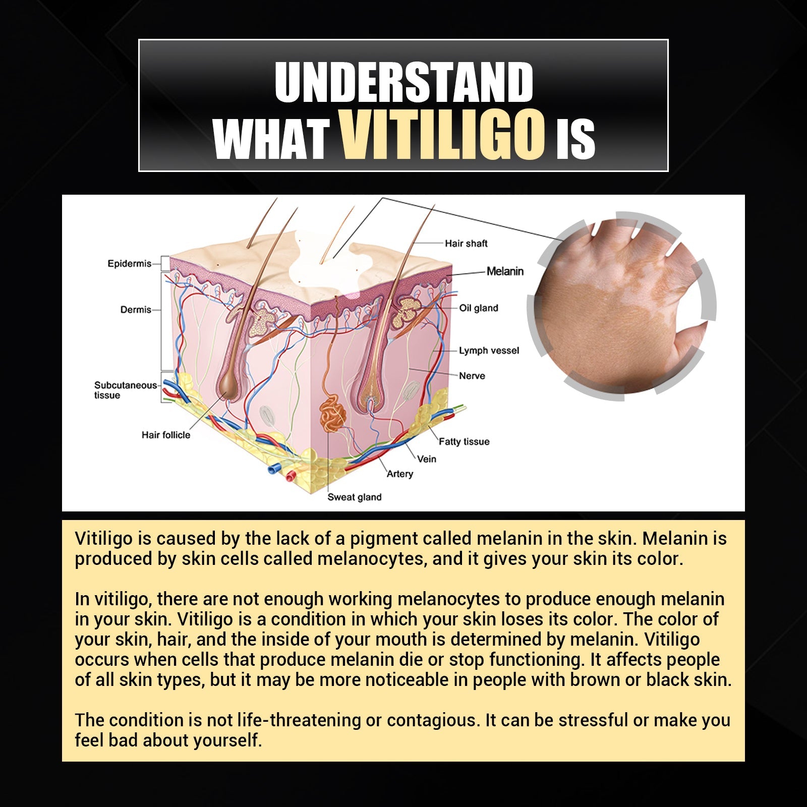 Woman's face with text claims and hand showing vitiligo before/after comparison