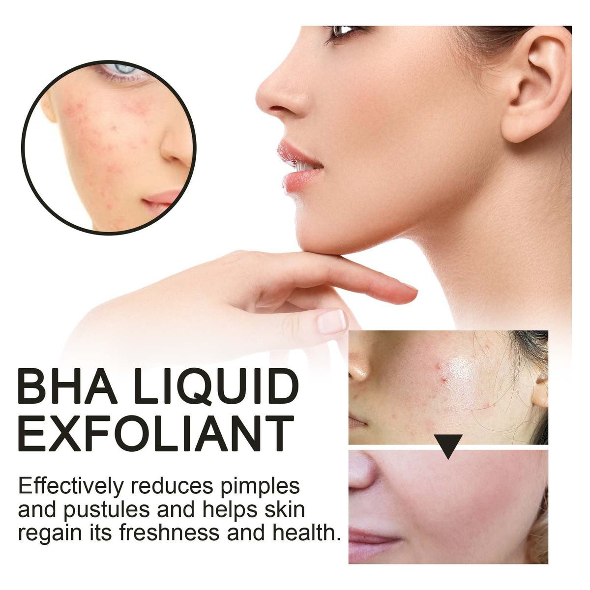 2% BHA Liquid Exfoliant for Clogged Pores & Acne