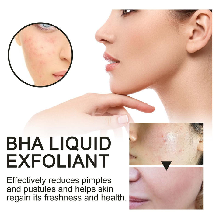 2% BHA Liquid Exfoliant for Clogged Pores & Acne