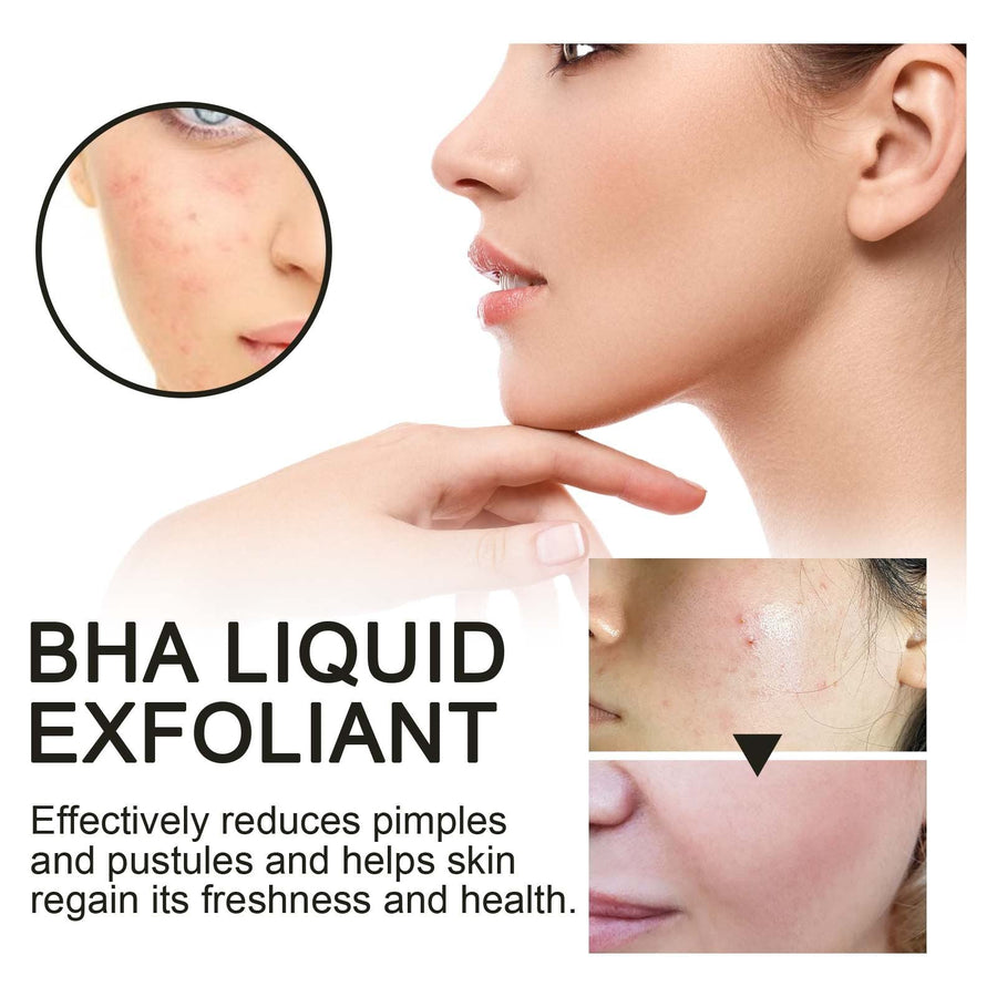 2% BHA Liquid Exfoliant for Clogged Pores & Acne