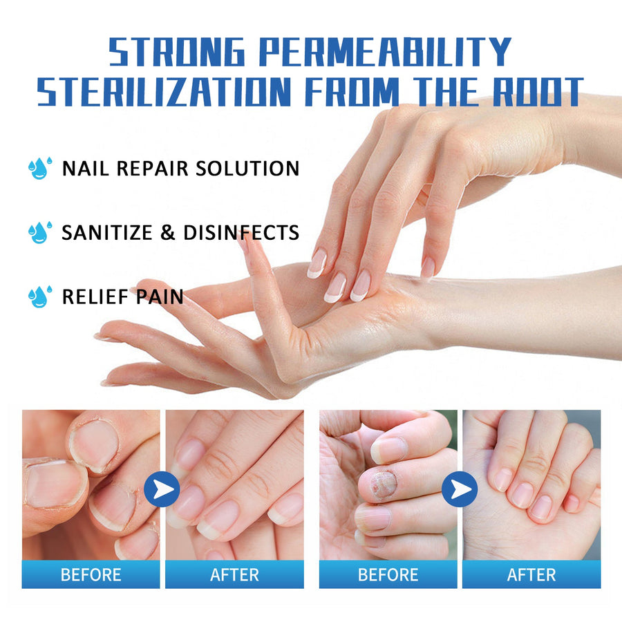 Nail Fungus Treatment Cream — Visible Results in Weeks