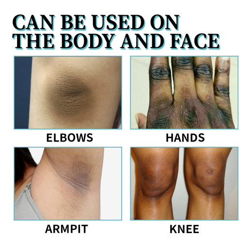 Acanthosis Nigricans Therapy Lotion for Dark Skin Patches