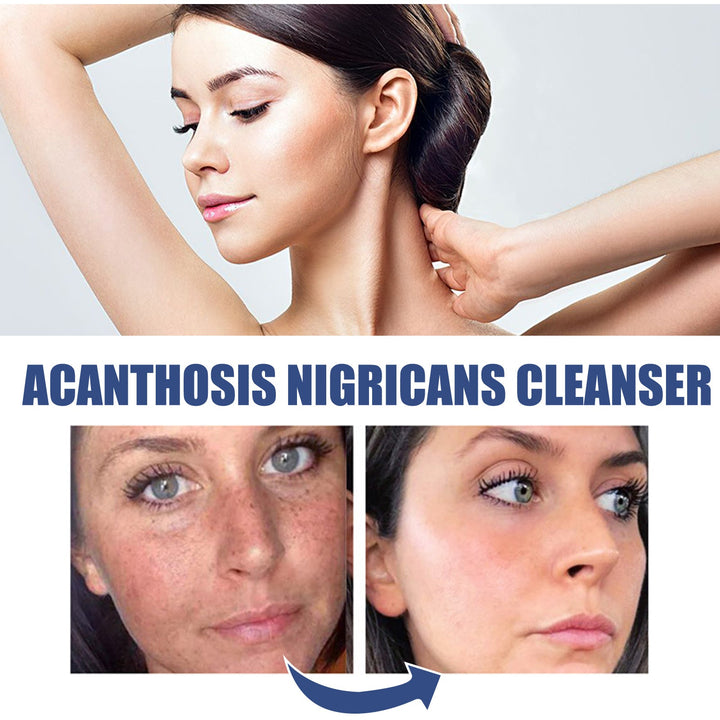 Acanthoderm Face Cleanser for Oily, Breakout-Prone Skin