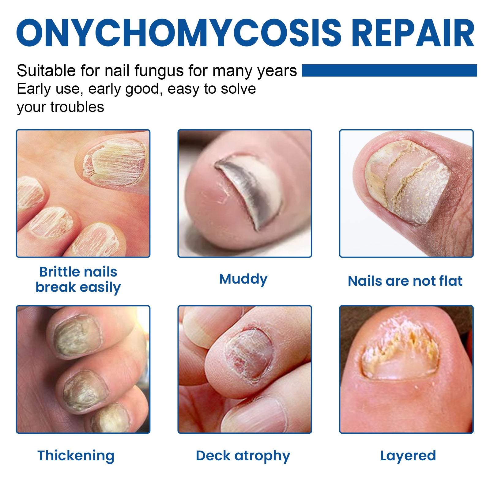 Grid of six fungal nail conditions: brittle nails, muddy appearance, non-flat shape, thickening, deck atrophy, layered nails