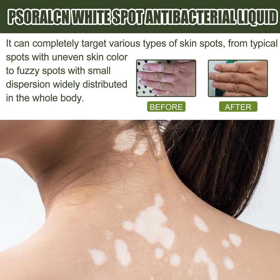 White Spot Purifying Serum – Brighten Uneven Skin Tone