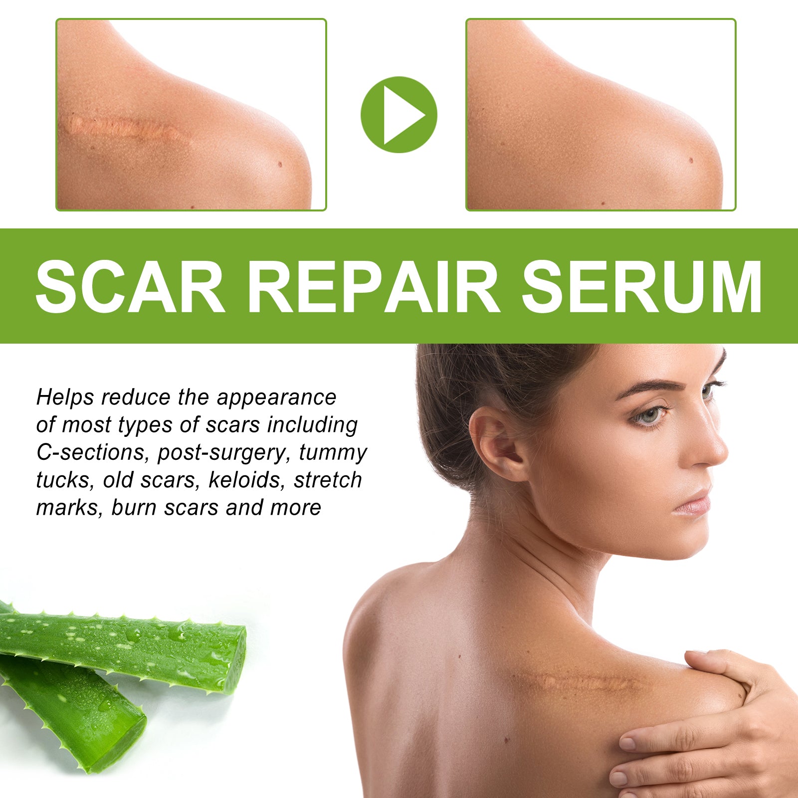 Split-screen comparison of shoulder/chest keloid scar before (left) and after (right) with play button and aloe ingredient imagery