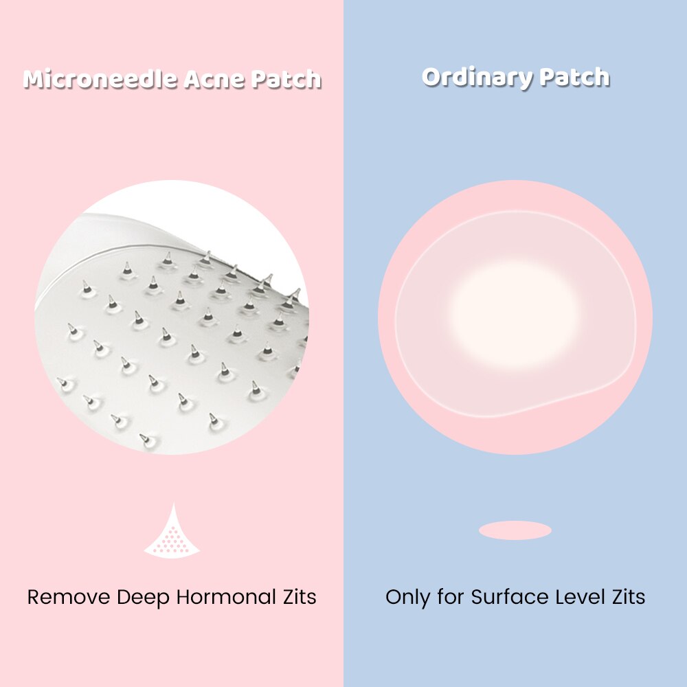 Split comparison showing forehead and profile views before and after treatment with visible acne reduction
