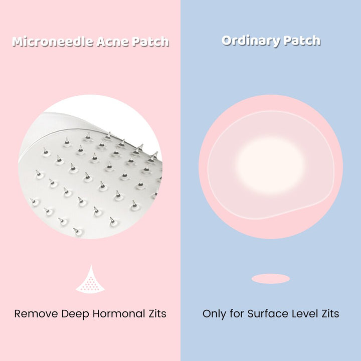 Microneedle Pimple Patches — Targets Deep Hormonal Acne