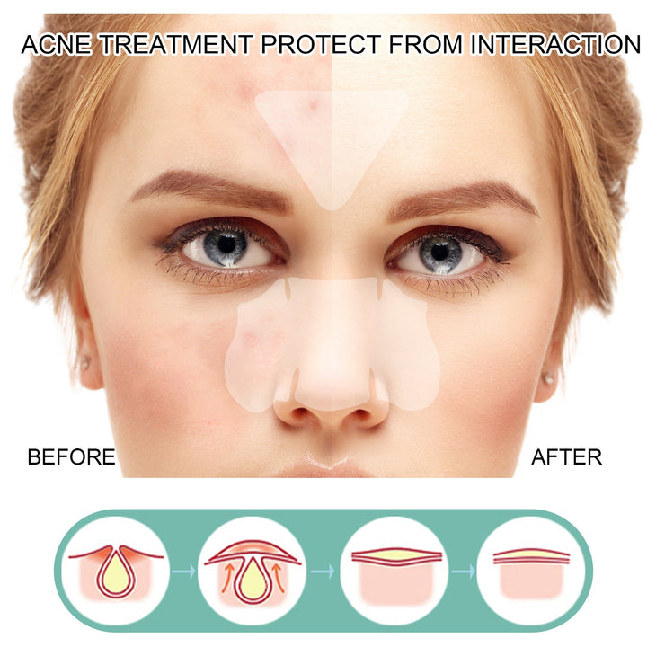 Face Pimple Patches — 132 Invisible Healing Spots for All