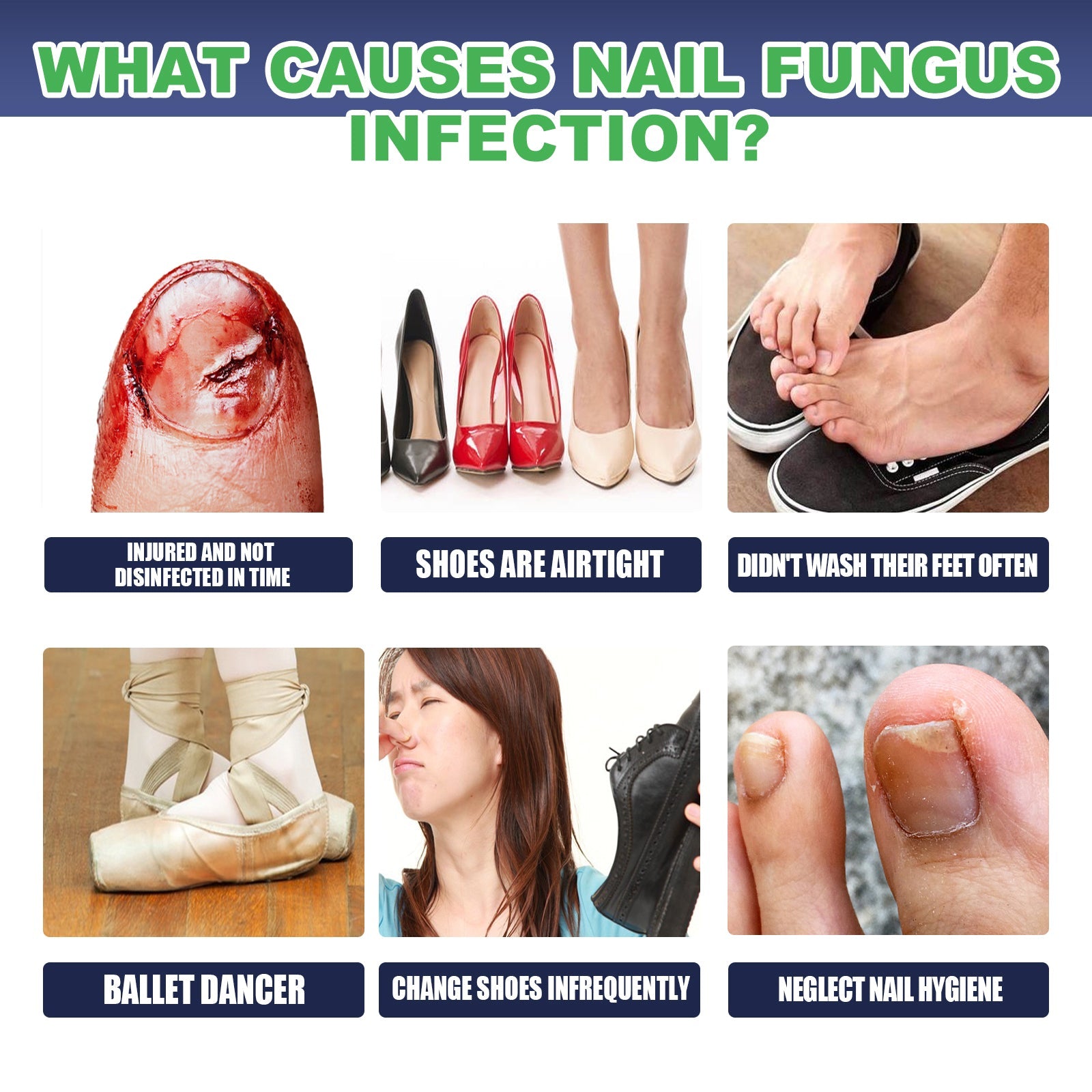 Educational infographic titled 'What Causes Nail Fungus Infection' showing 6 risk scenarios with visual examples