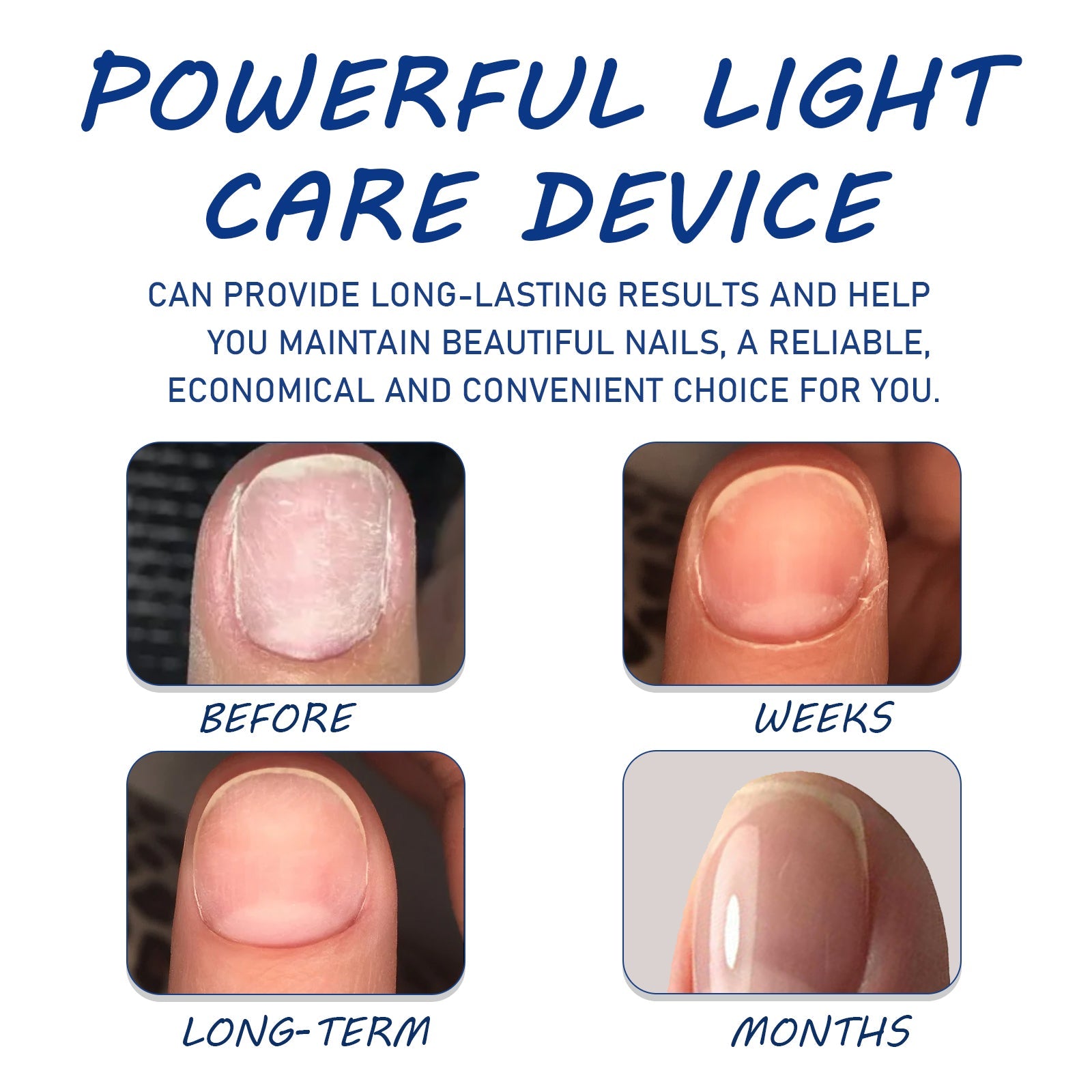 Four-panel progression showing nail transformation from pale/damaged appearance (before) through weeks and long-term improvement to fully clear, healthy nails (months)
