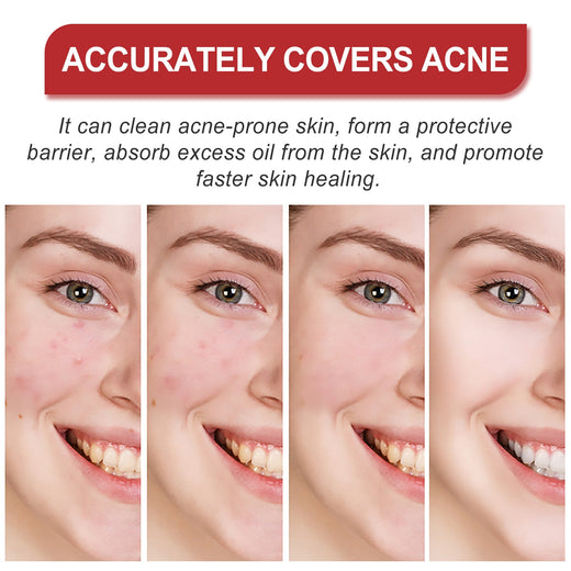 Hydrocolloid Acne Patches - Cute Shapes, 180 Count Pack