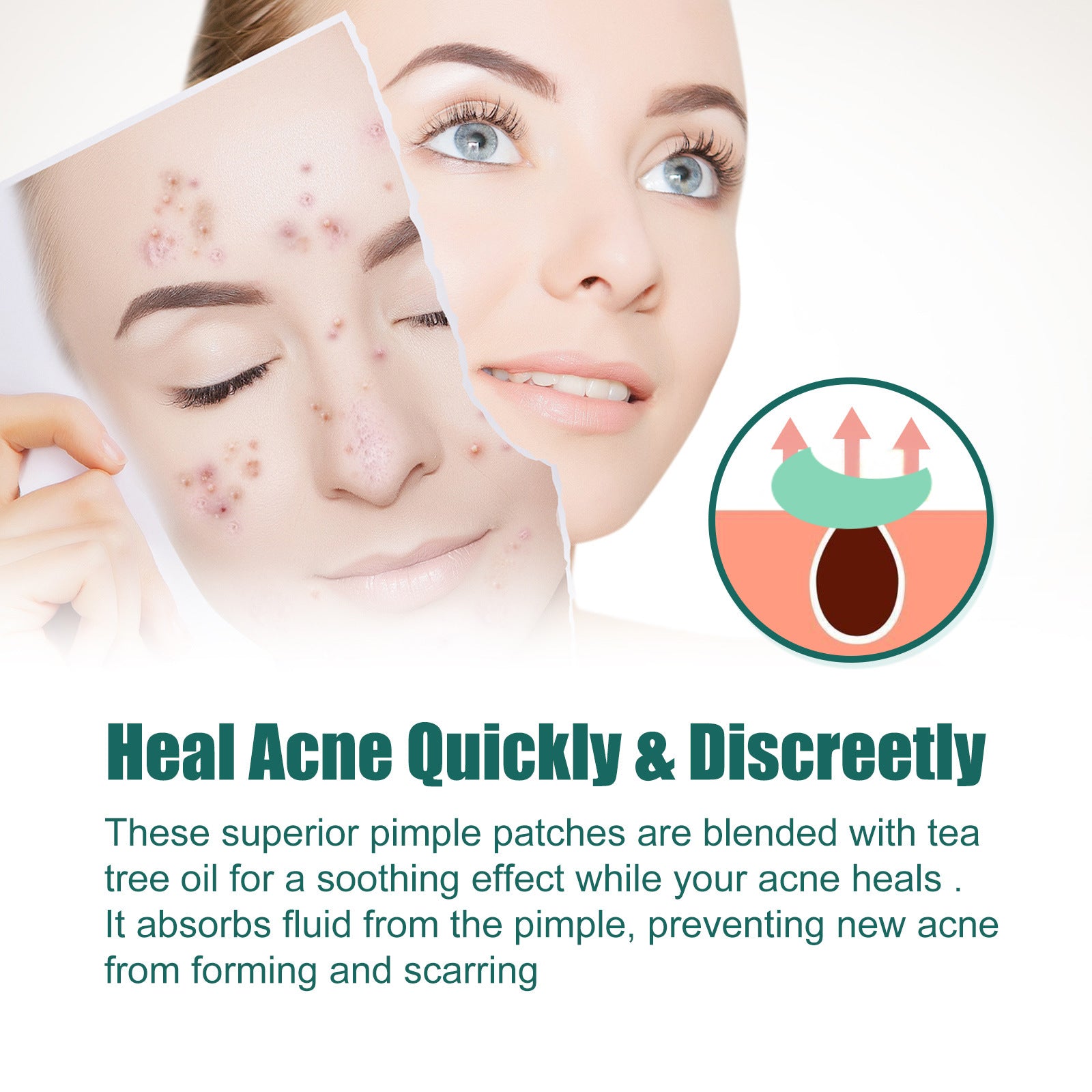 Educational infographic showing how pimples form with red arrows indicating fluid absorption and green patch absorbing from pore, hero claim headline