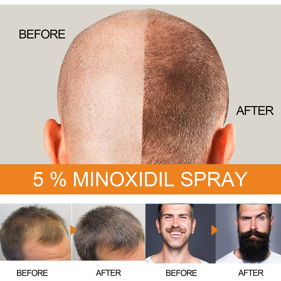 Minoxidil Hair Growth Spray for Men | 5% Treatment