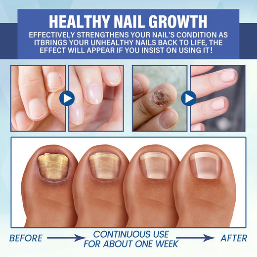 LED Nail Repair Treatment — Clear Fungus & Restore Nail