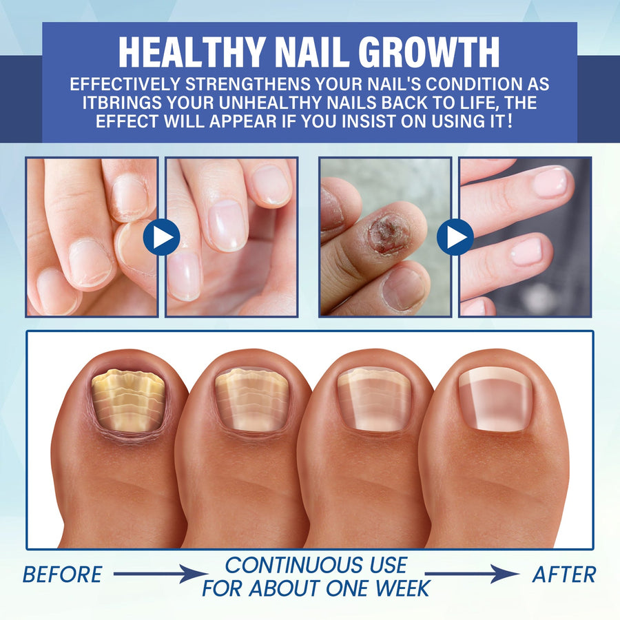 LED Nail Repair Treatment — Clear Fungus & Restore Nail