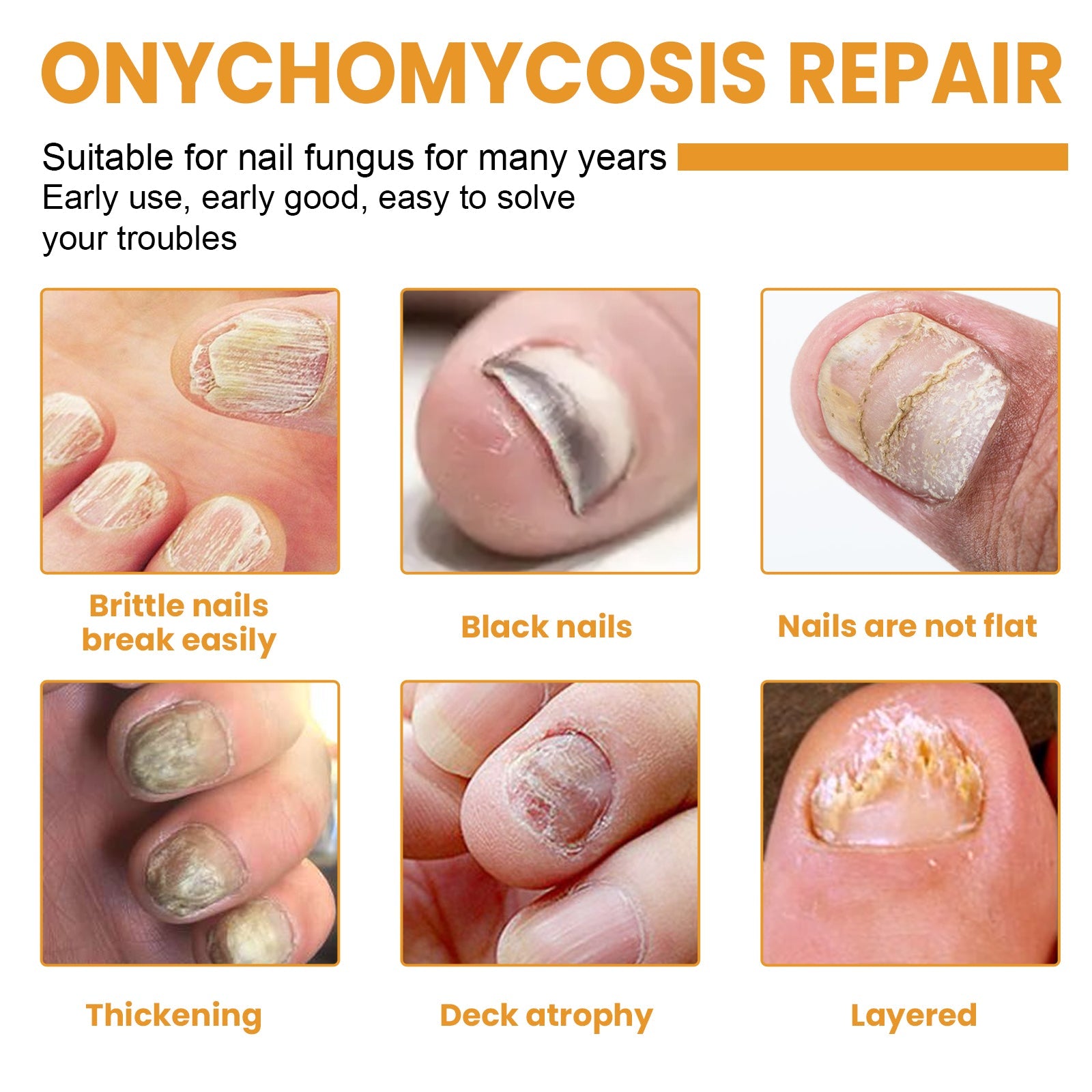 Grid of six medical photographs showing various fungal nail conditions: brittle nails, black nails, unflat nails, thickening, deck atrophy, and layered nails with orange text labels