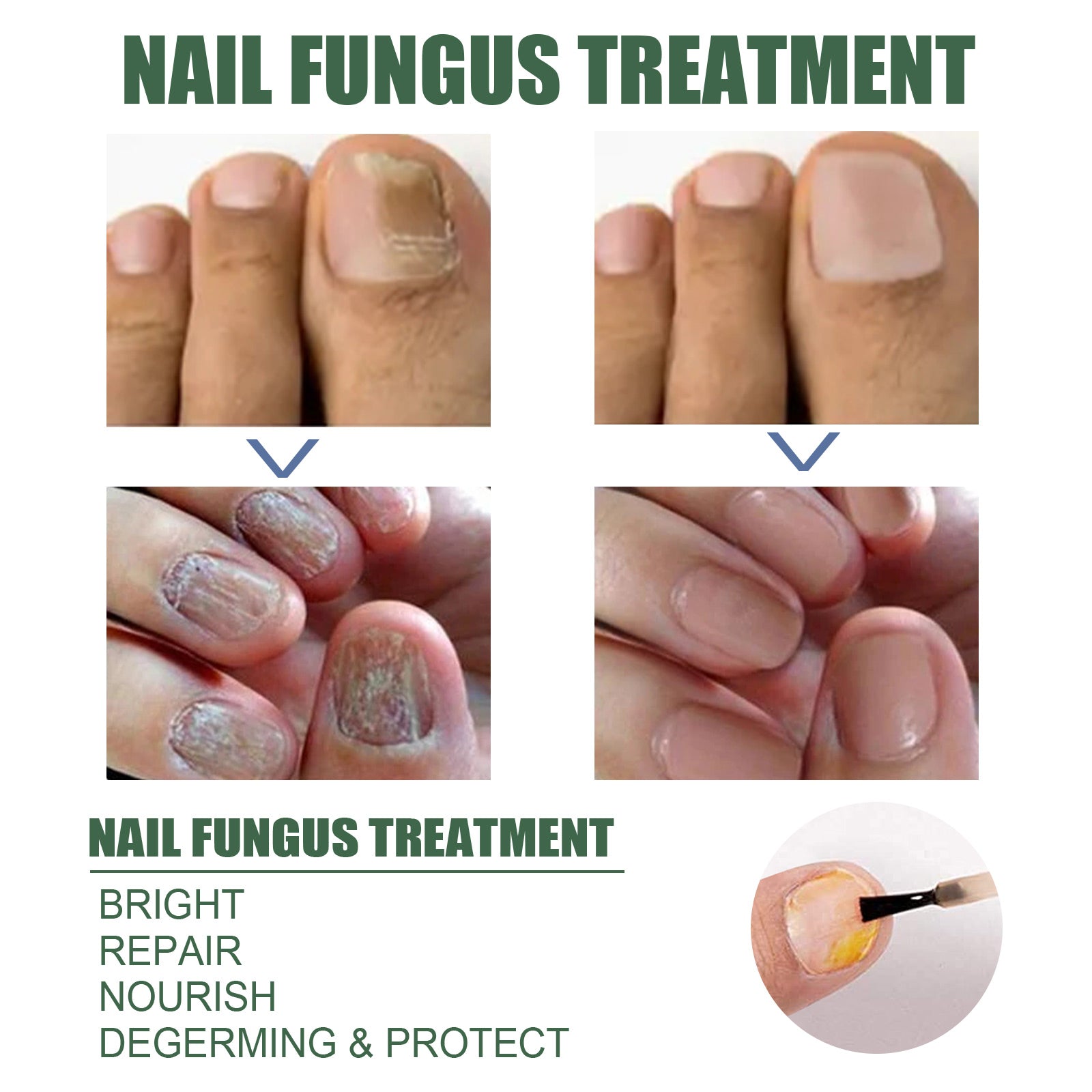 Dual before/after comparison of multiple fingernails showing thick ridged infected nails transforming to smooth clear healthy nails; includes treatment benefits text and brush applicator closeup