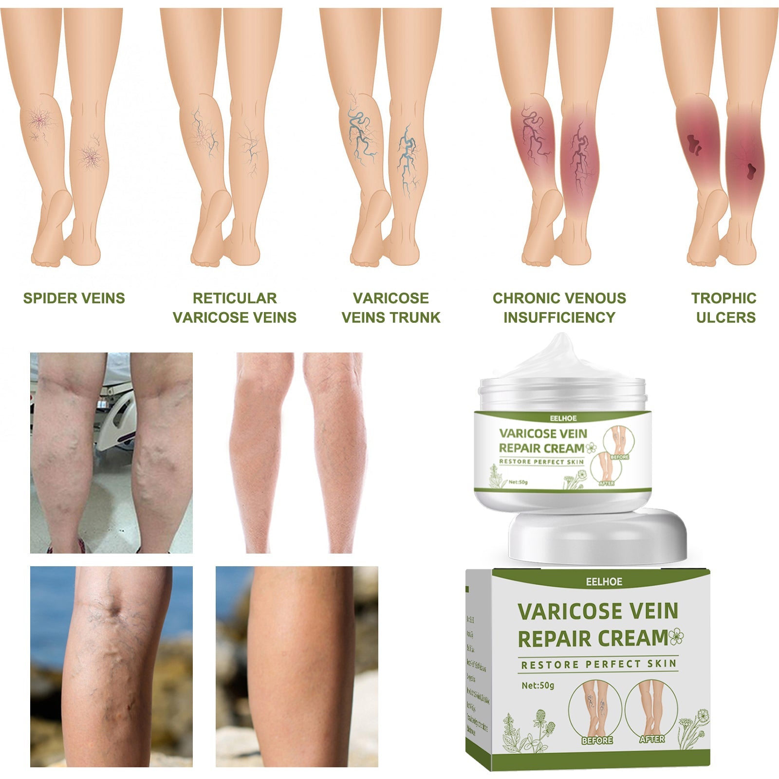Multiple leg condition severity levels showing spider veins through trophic ulcers