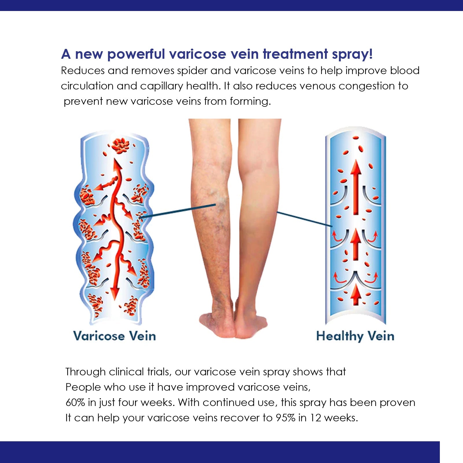 Medical diagram showing varicose vein condition versus healthy vein circulation with blood flow arrows
