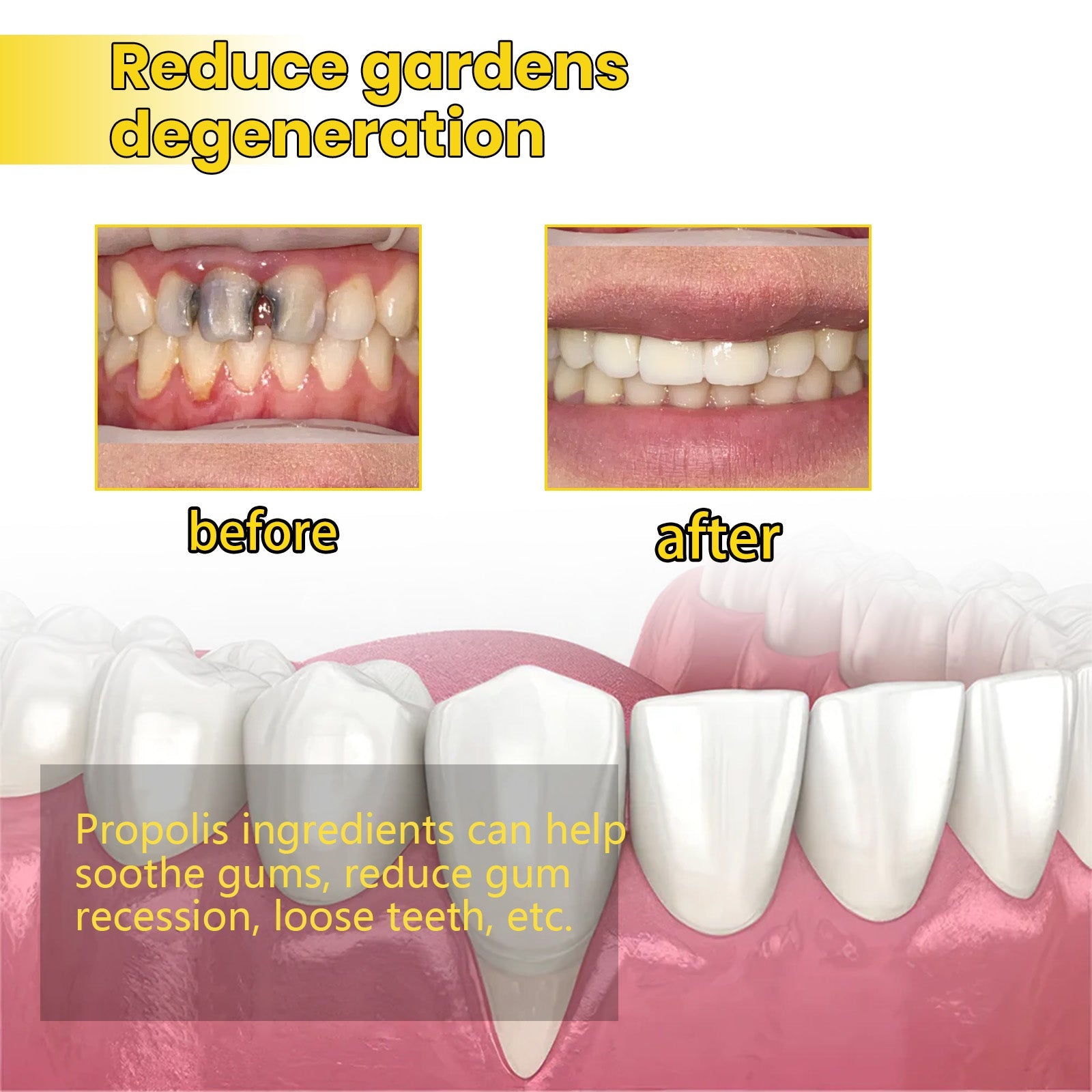 Clinical before/after demonstration showing severe gum degeneration transforming to healthy restored gums