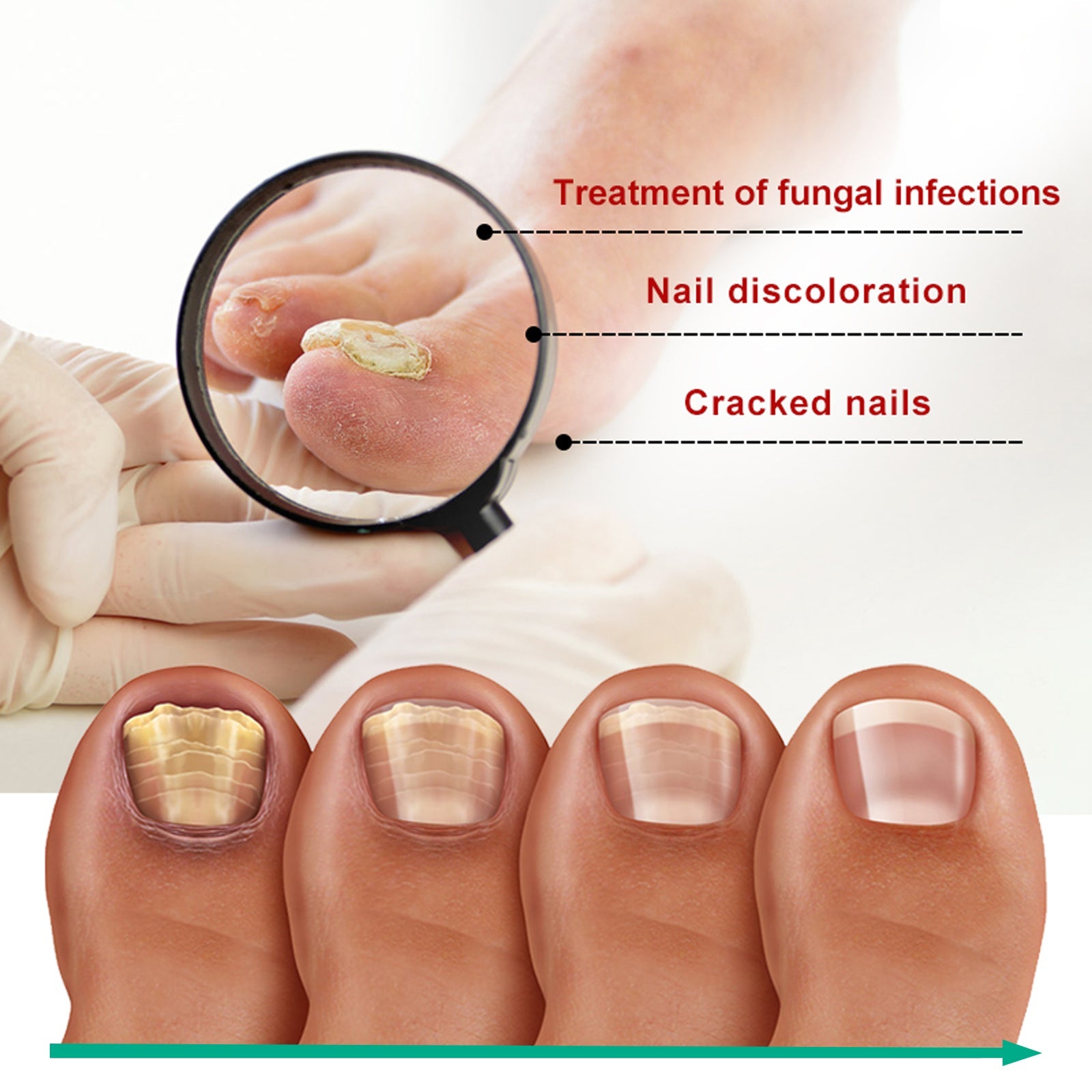 Before and after nail transformation showing yellowed infected nail becoming clear healthy nail; hands displaying treated healthy skin