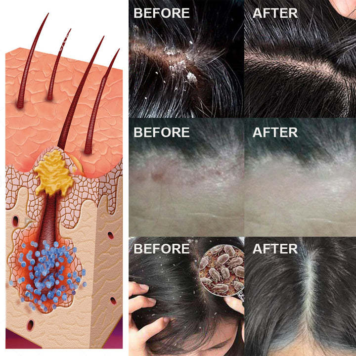 Scalp Serum for Dandruff and Follicle Relief