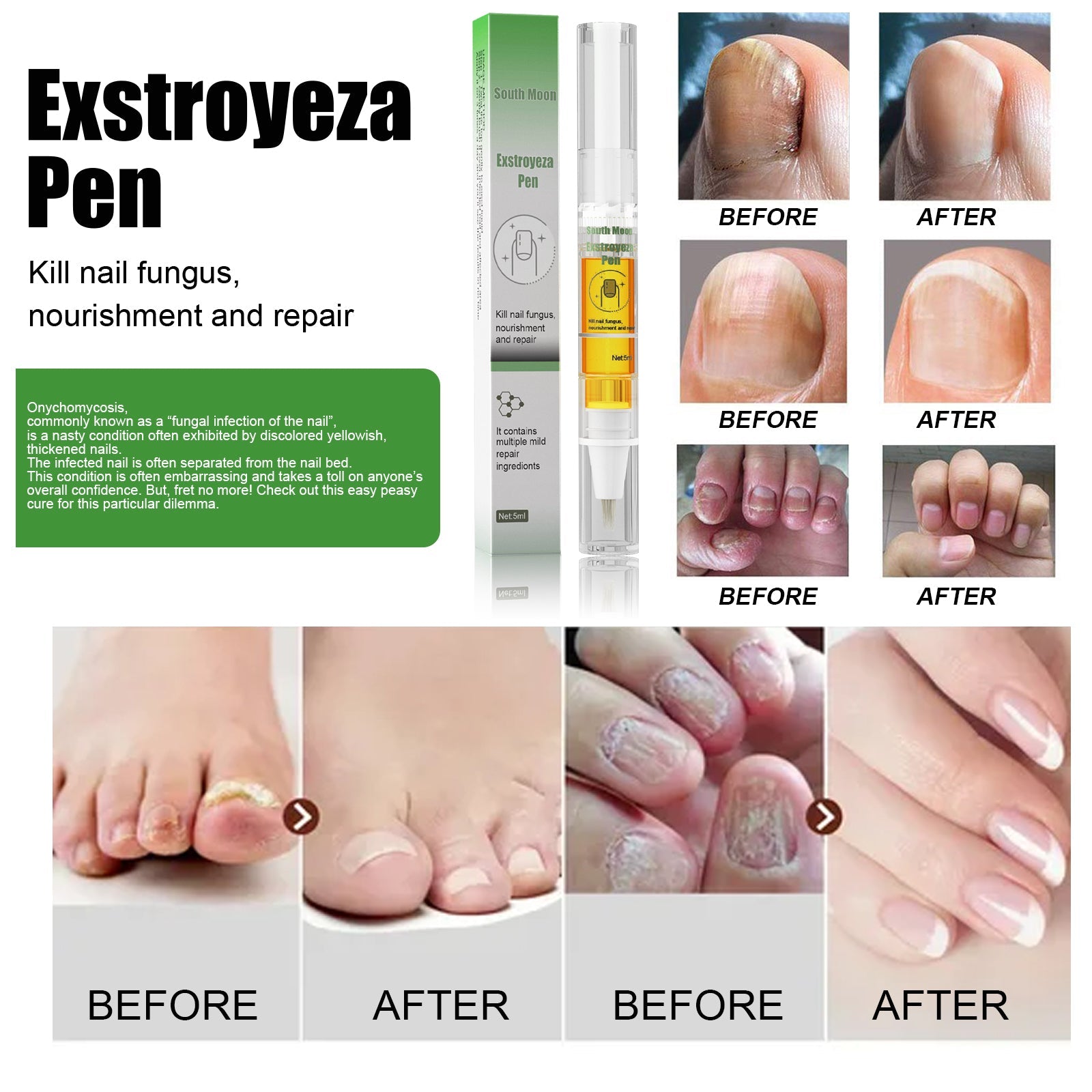 Comprehensive before-and-after gallery showing nail fungus transformation on fingernails and toenails with technical information about onychomycosis