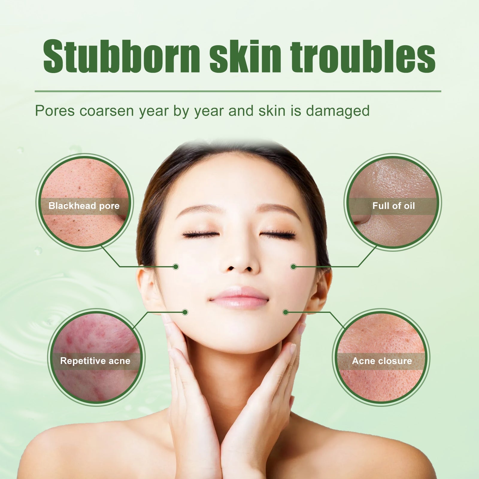 Educational diagram showing four body areas affected by acne: face, chin, neck, and back with close-up acne imagery