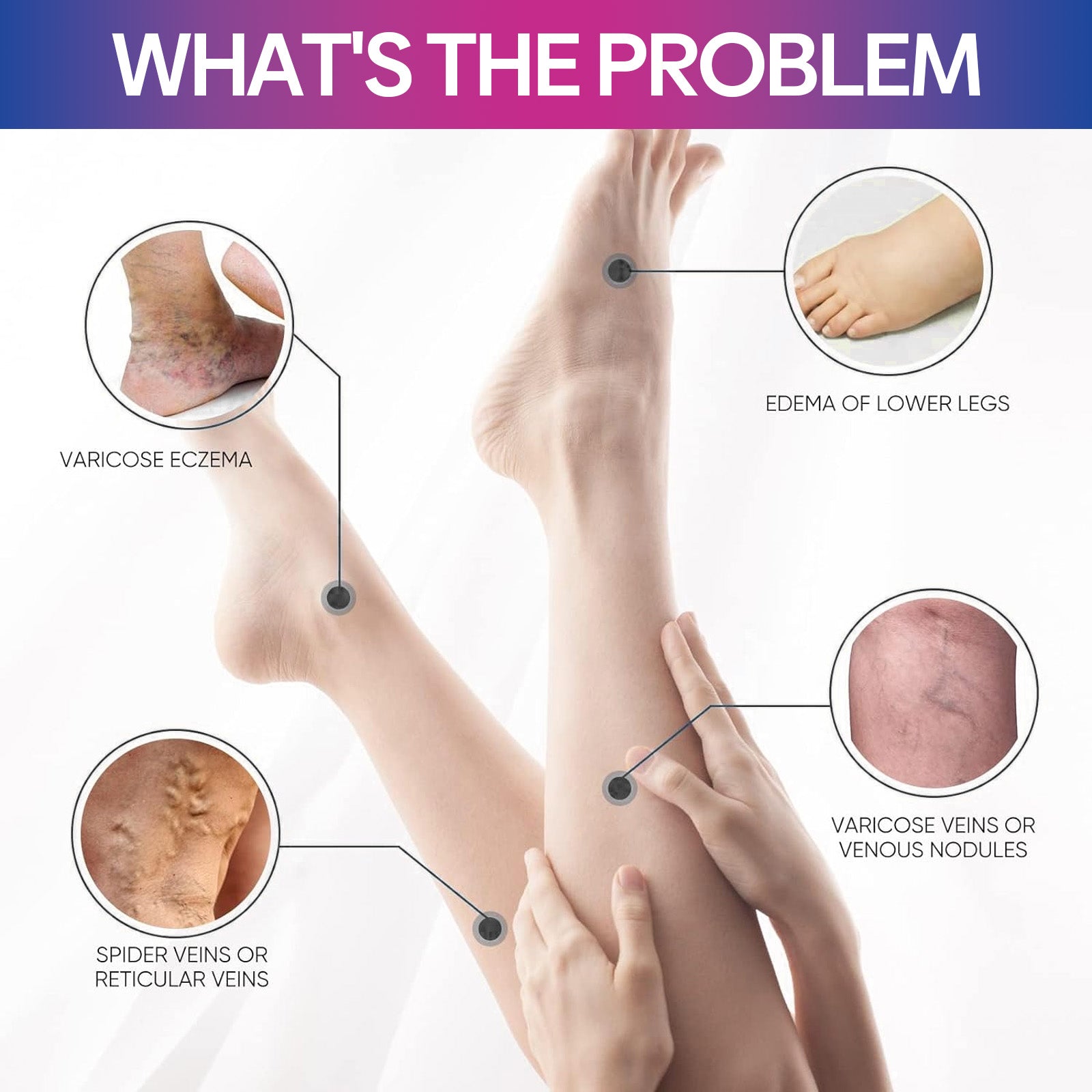 Diagnostic chart showing four specific leg problems: varicose eczema, spider veins, varicose veins/venous nodules, and lower leg edema with labeled close-ups