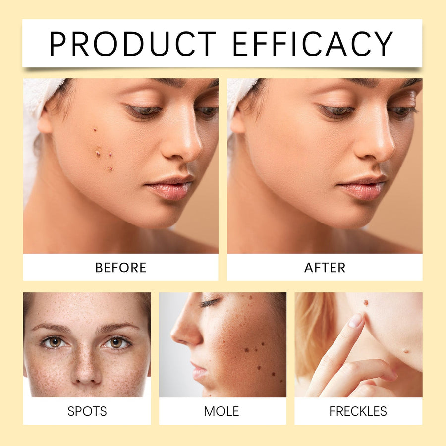 Anti-Freckle Serum for Dark Spots & Uneven Skin Tone