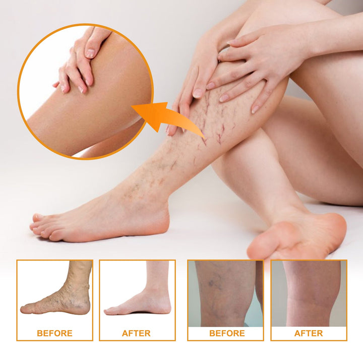 Vitamin K Cream for Spider Veins & Leg Discoloration