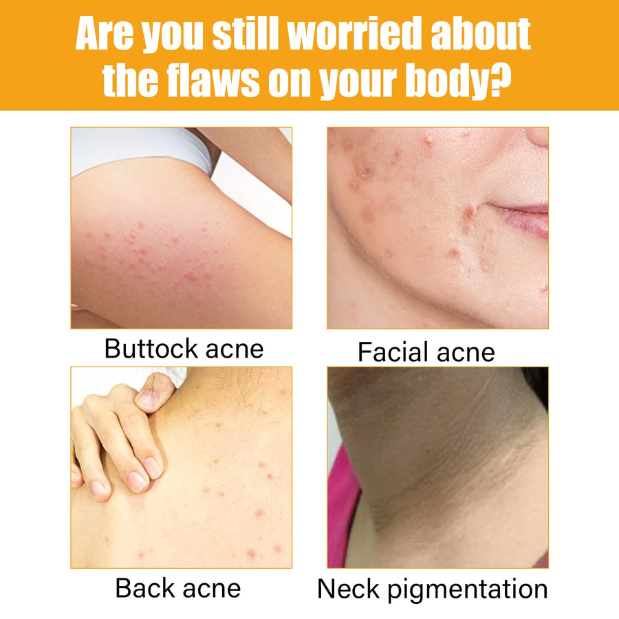 Vitamin C Acne Serum for Clearer, Nourished-Looking Skin