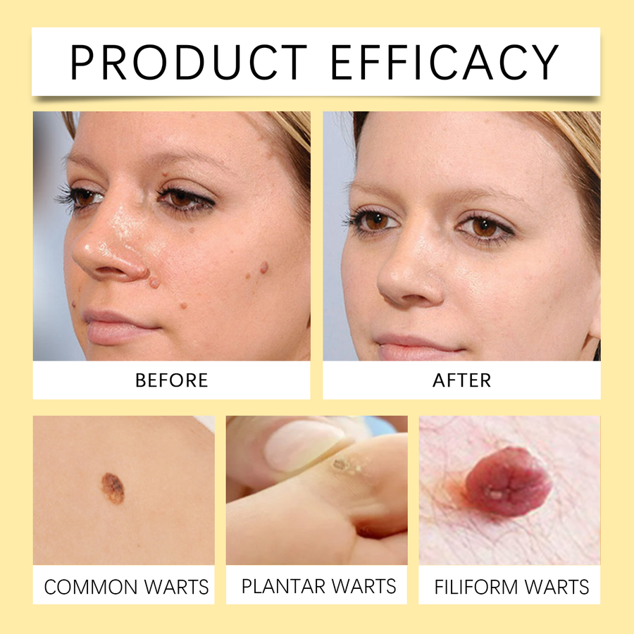 Bee Venom Wart & Mole Removal Spray, Gentle Cleansing Skin M