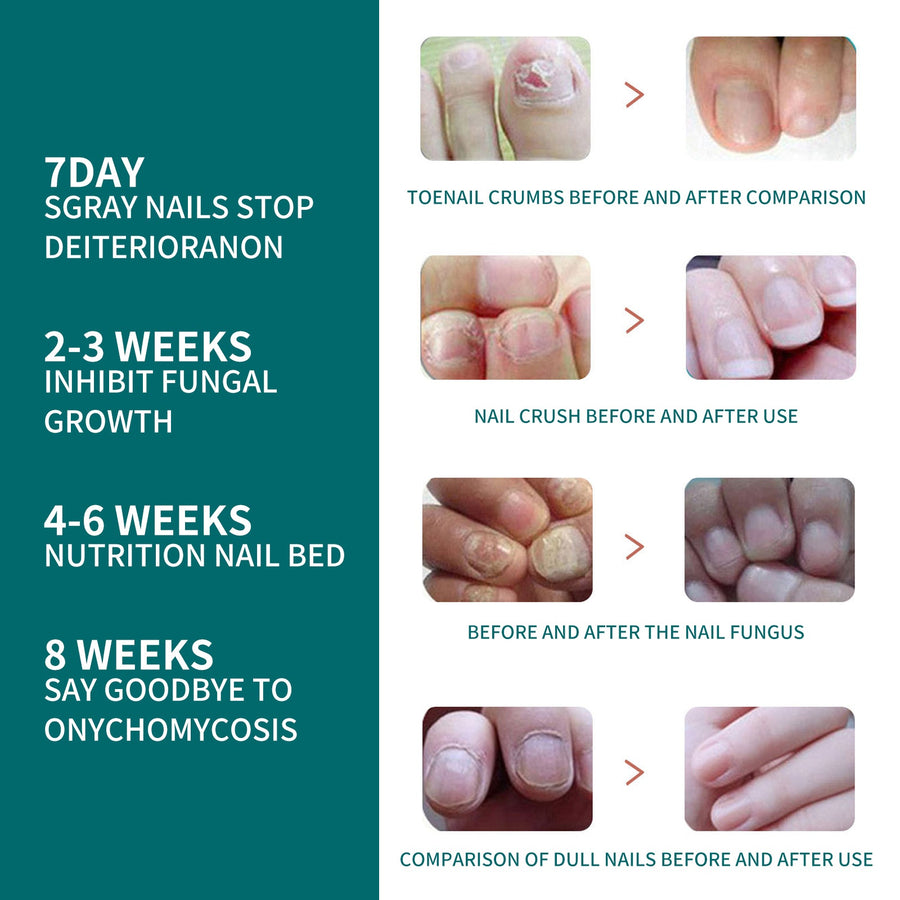 Toenail Fungus Treatment Roll-On - Visible Results in 7 Days