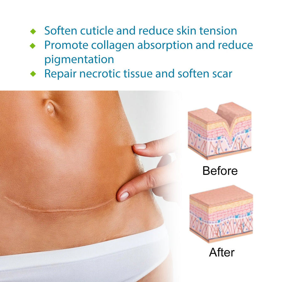 Silicone Scar Treatment — Cut-to-Fit Smoother-Looking Care