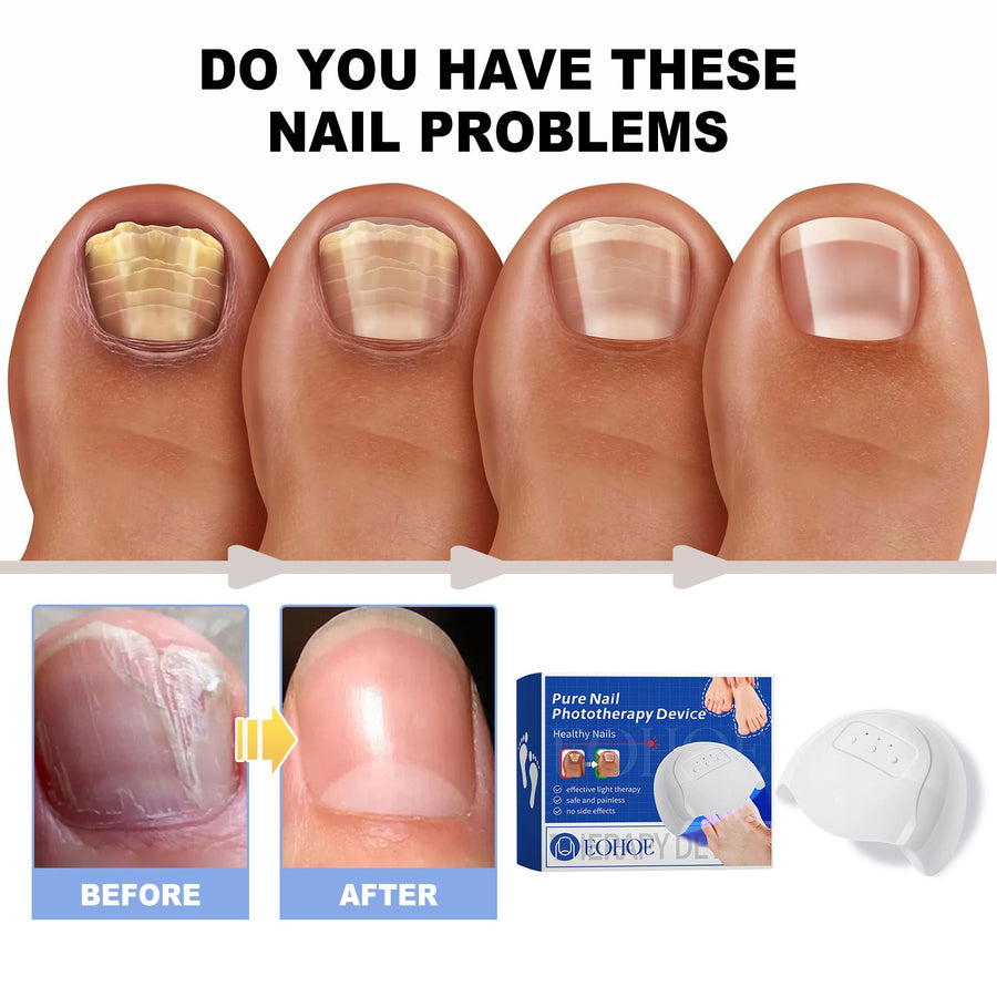Nail Phototherapy Device — Healthier-Looking Nails at Home