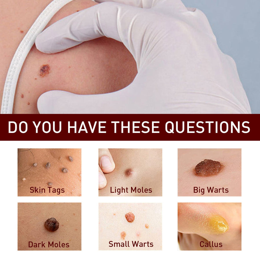 Liquid Wart Removal Pen — Flatten Skin Tags & Warts in 5 Days