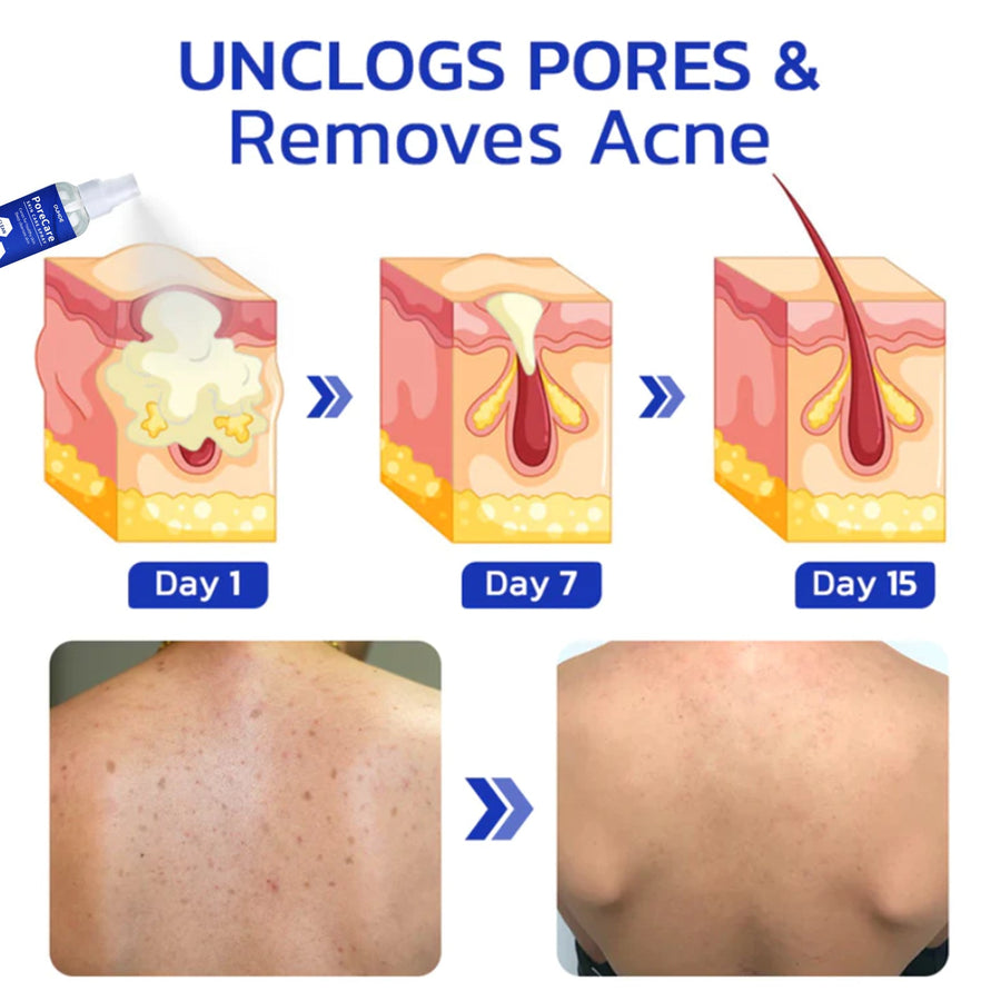 Porecare Skin Care Spray, Cleanser Warts Fade Moles Corns Sm