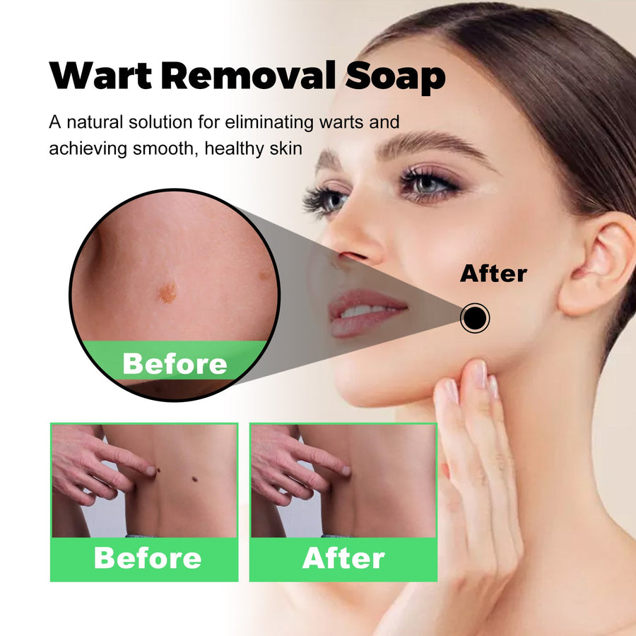 Skin Tag & Wart Removal Soap — Pain & Scar-Free Treatment