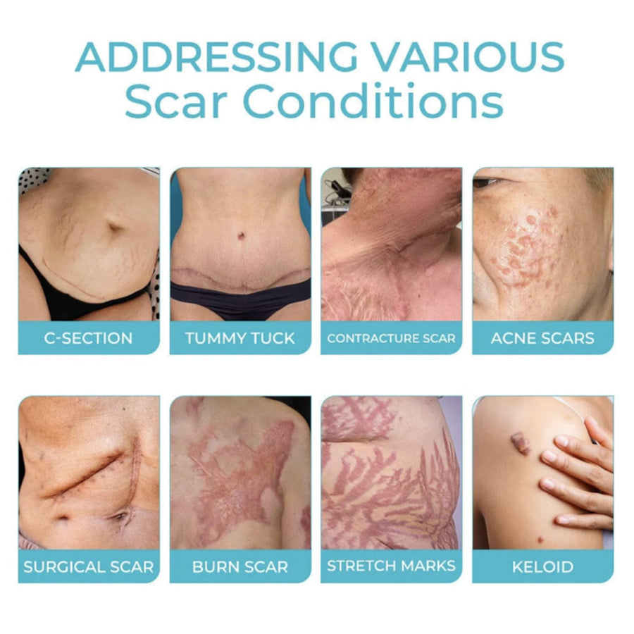 Skin Scar Treatment Spray — New Scars Fade in 2 Weeks, Old