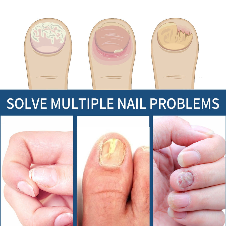 Fungal Toenail Treatment Patches — Visibly Clearer Nails