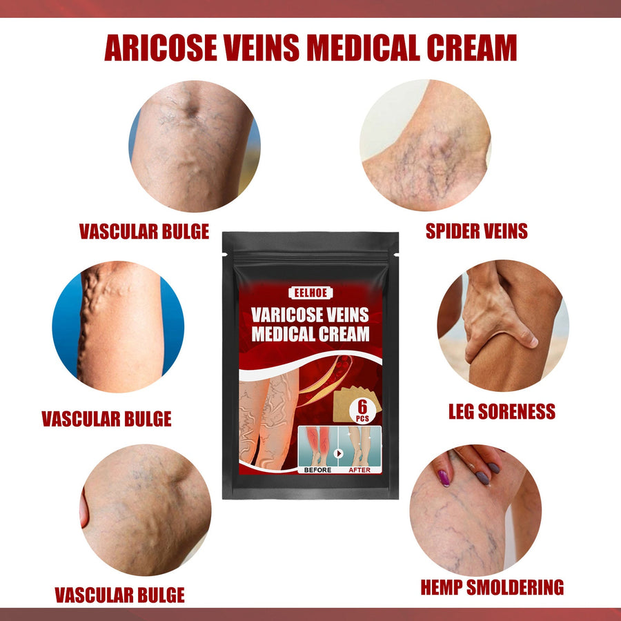 Varicose Vein Cream & Patches — Smoother Legs, Less Swelling