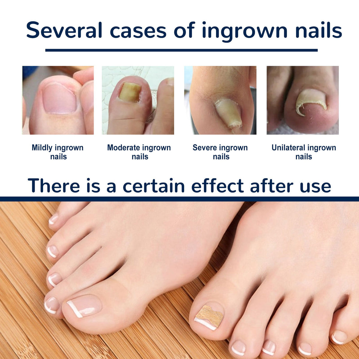 Ingrown Toenail Correction Patch Kit - Pain Relief 50pk