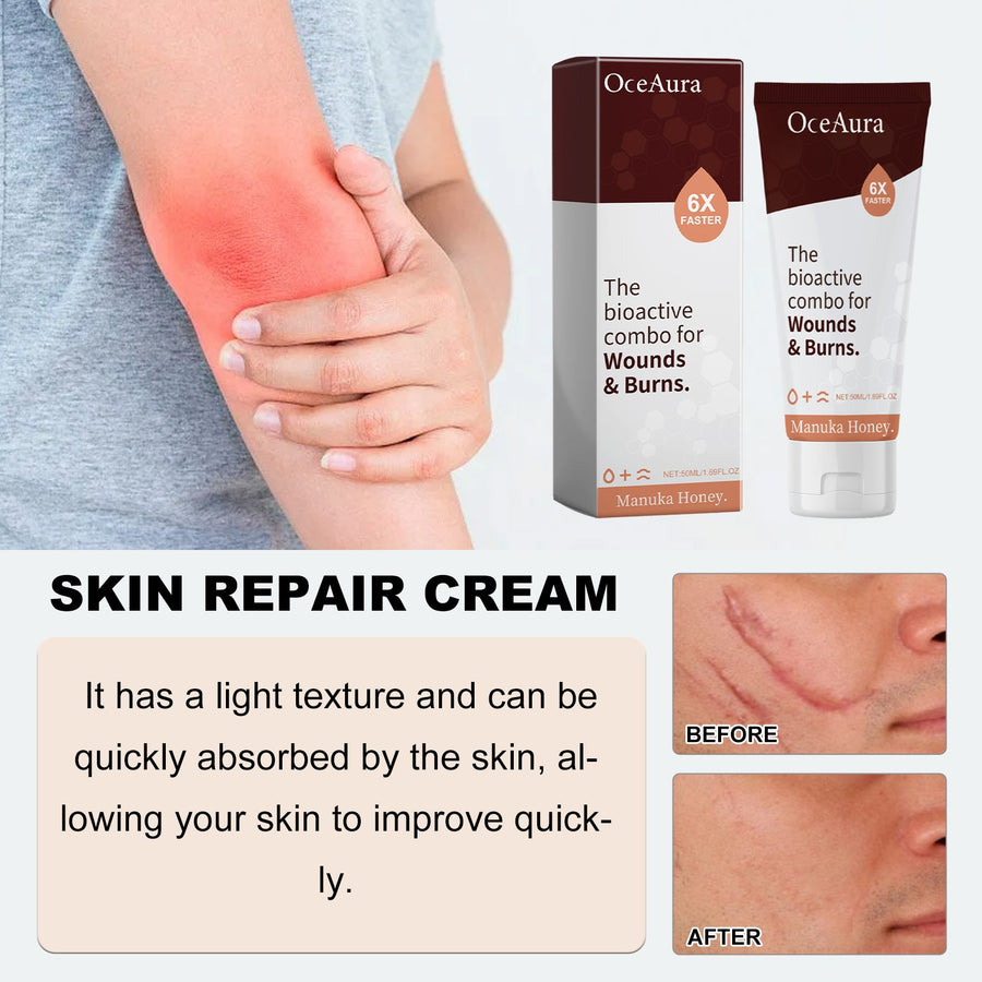 Manuka Honey Wound & Burn Cream, 6X Faster Skin Repair