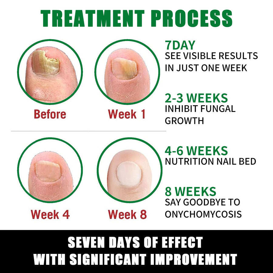 Nail Fungus Treatment With Ginger Plant-Based Formula
