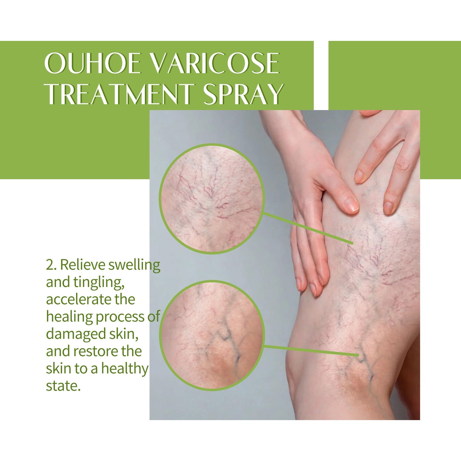 Three close-up comparisons labeled MILD, MODERATELY, SEVERE showing varying stages of varicose vein appearance
